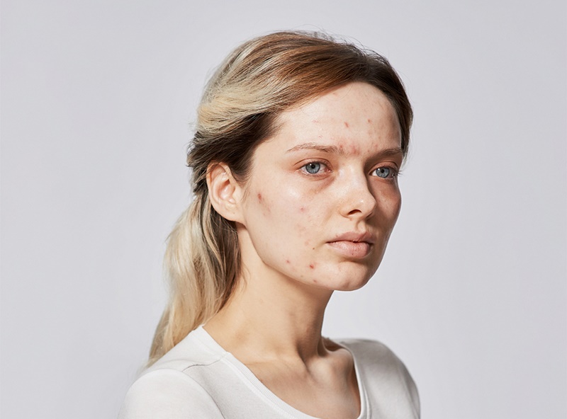 Em Ford is a beauty blogger. She has quite serius acne, but has learned to apply here makeup to conceal it. Photographed without any makeup at all and with full makeup. Photography By Amit Lennon Date: 9 July 2015