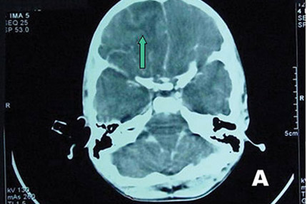 Bệnh nhân đầu tiên đã nhiễm “amip ăn não” thế nào?