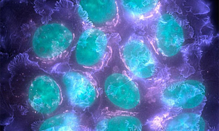 Xác định được các gene đột biến có khả năng gây bệnh ung thư vú