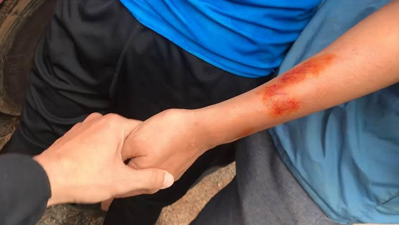 Cú đâm mạnh đến độ phần thân sau của chiếc xe bị biến dạng, diễn viên Kiều Minh Tuấn đứng gần đó cũng bị mảnh vụn của các cột đá văng trúng cánh tay.