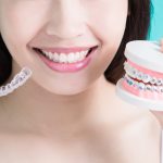 Invisalign – Bí quyết niềng răng chỉnh hô, móm, răng khấp khểnh cho người trưởng thành
