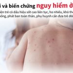 [Infographics] Những biến chứng nguy hiểm của bệnh sởi ở trẻ em