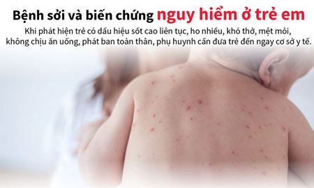 Infographics] Những biến chứng nguy hiểm của bệnh sởi ở trẻ em - Tạp chí Đẹp