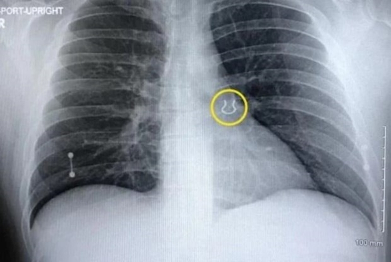 khuyen mui nam trong phoi 1 - Người đàn ông tìm thấy khuyên mũi trong phổi sau 5 năm thất lạc