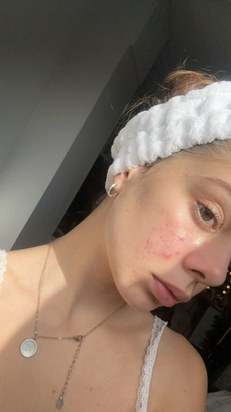 ngan-ngua-va-dieu-tri-mun-trung-ca